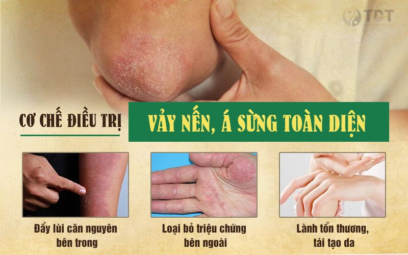 Cơ chế điều trị bệnh bảy nến