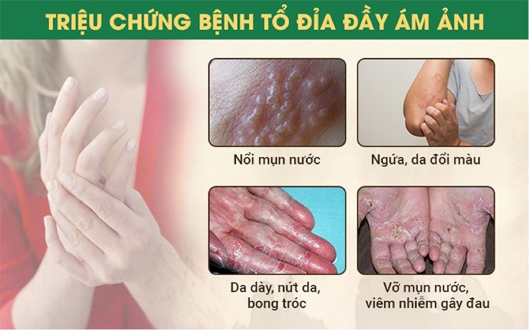 Bệnh tổ đỉa