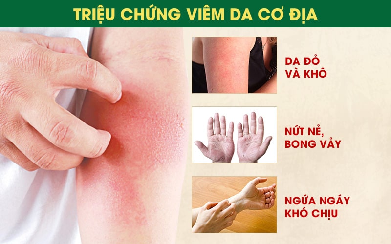 Bệnh viêm da cơ địa