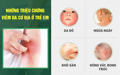 Triệu chứng viêm da cơ địa trẻ em