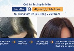 Quá trình chuyển biến từ hói đầu thành dày mượt, chắc khỏe tại Trung tâm Da liễu Đông y Việt Nam