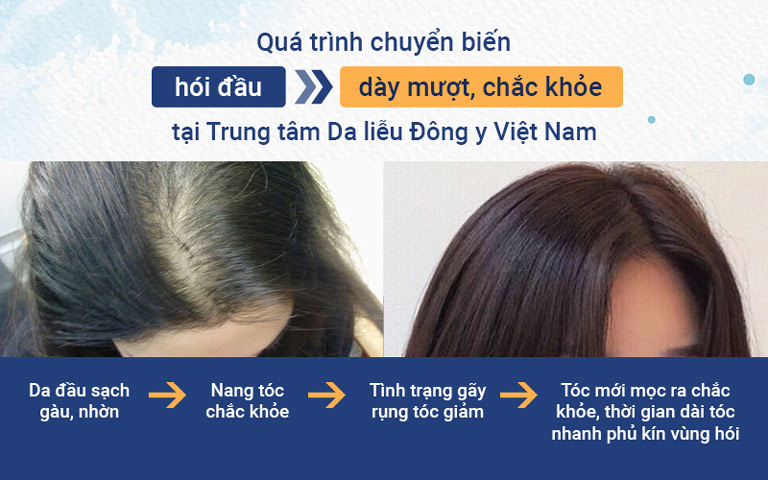 Những nguyên nhân gây rụng tóc bạn cần lưu ý