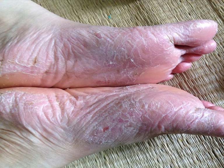 Bong tróc và nứt nẻ ngoài da là đặc điểm chung của người bị bệnh á sừng ở chân