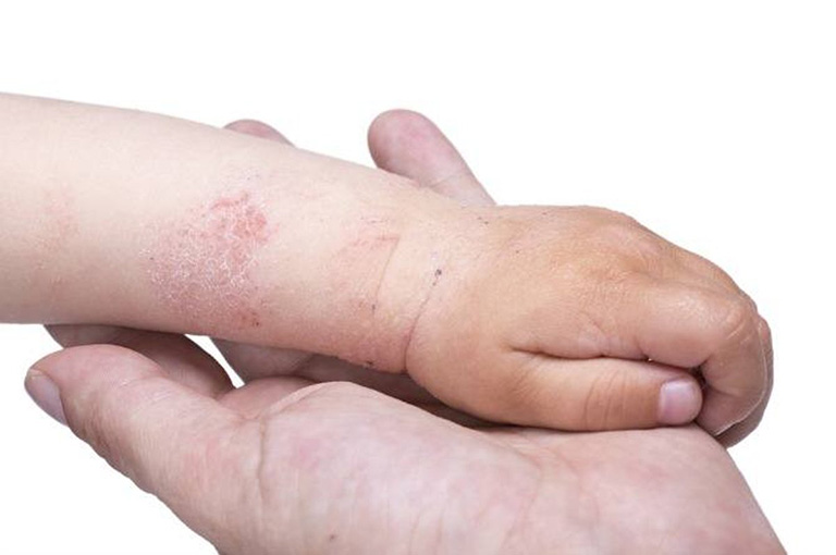 Bệnh chàm khô ở trẻ em có thể xuất hiện do nhiều nguyên nhân
