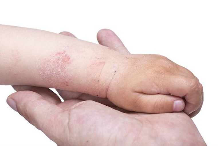 Bệnh Chàm Khô Ở Trẻ Em Và Cách Xử Lý An Toàn Bằng Thảo Dược