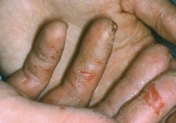 Bệnh gây bong tróc các vùng da
