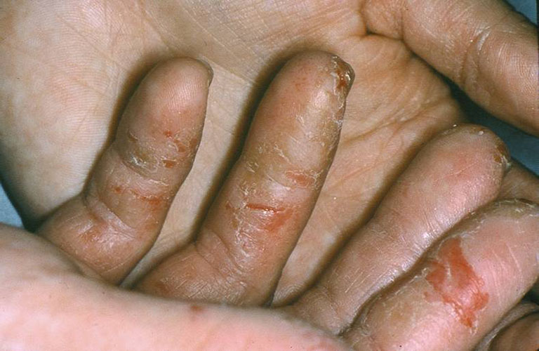 Bệnh gây bong tróc các vùng da