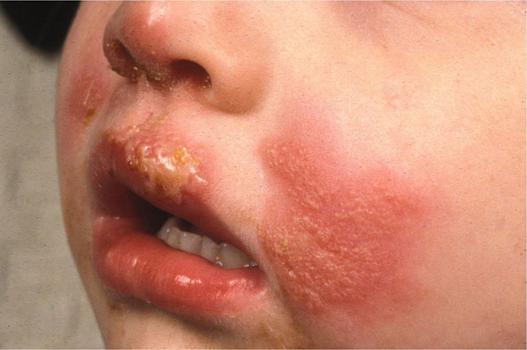 Các triệu chứng bệnh chàm bội nhiễm khiến trẻ khó chịu
