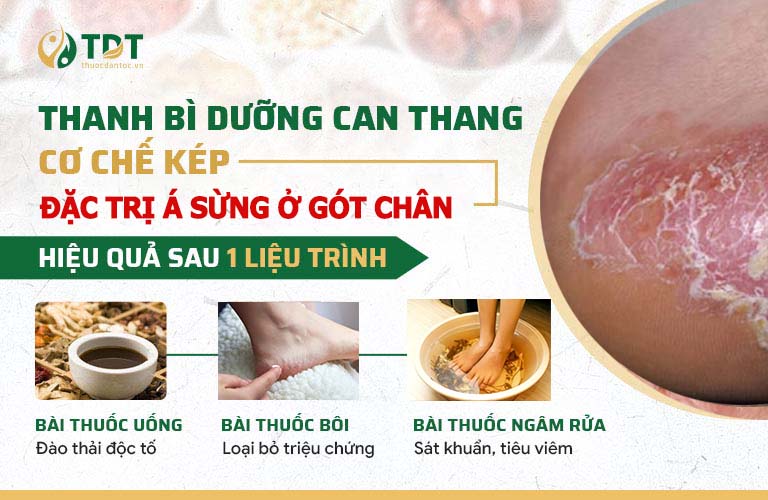 Bộ 3 nhóm thuốc cho hiệu quả chuyên sâu trong trị á sừng ở gót chân