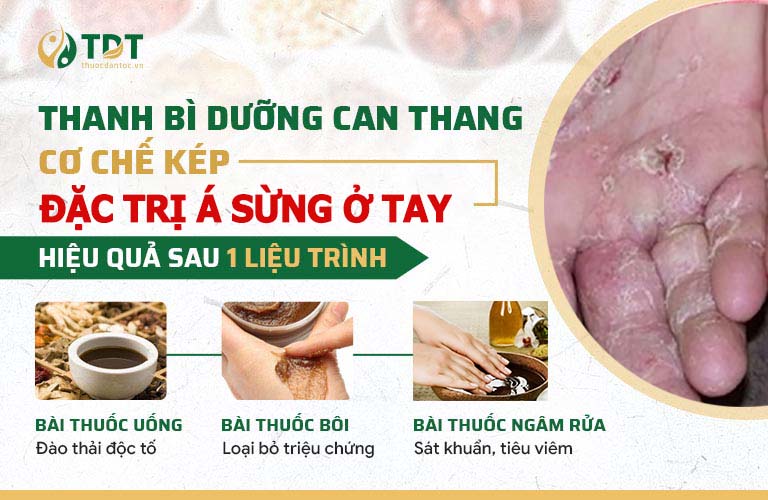 Bộ 3 nhóm thuốc đặc trị chuyên sâu á sừng ở tay