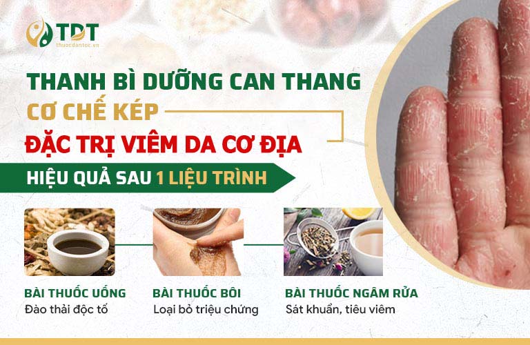 Công thức thuốc xử lý viêm da cơ địa ở tay chuyên sâu