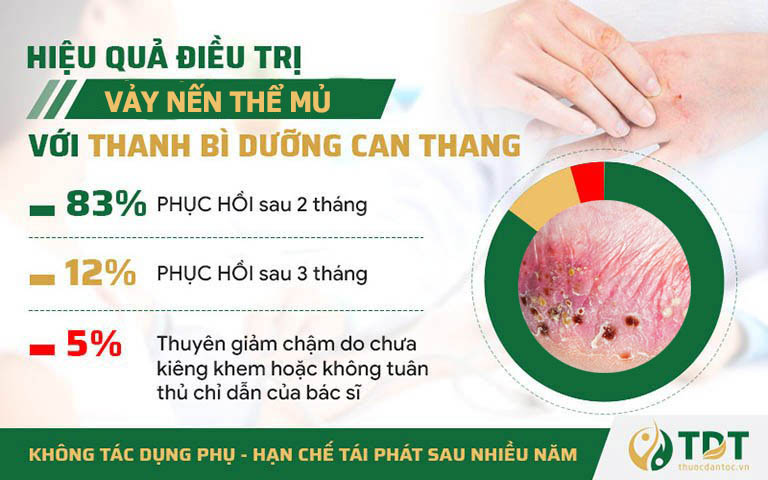 Vảy nến thể mủ được xử lý hiệu quả với Thanh bì Dưỡng can thang