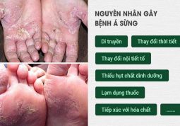 6 Nguyên Nhân Gây Bệnh Á Sừng Chủ Yếu, Tuyệt Đối Không Chủ Quan