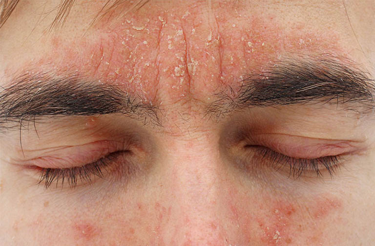 Bệnh tạo ra lớp dầu bóng trên bề mặt da